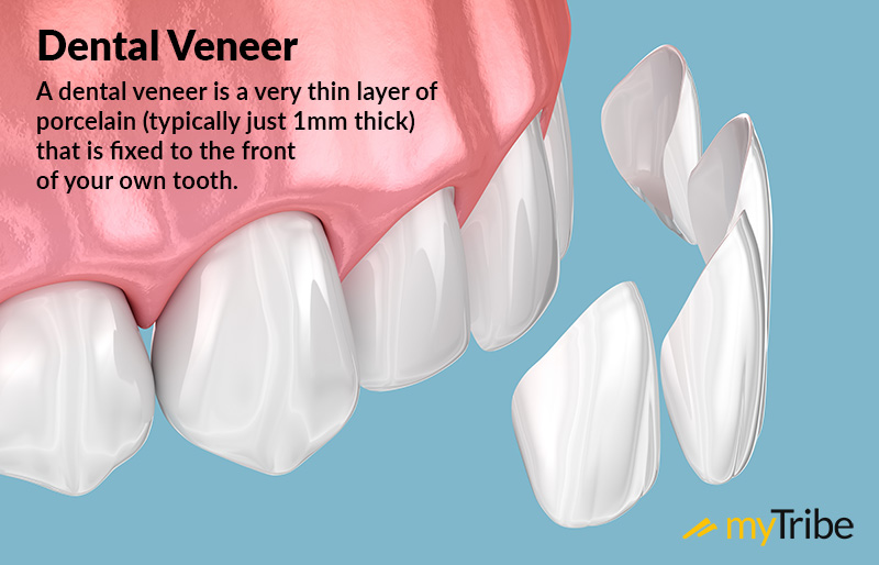 Veneers Vs. Crowns Pros And Cons And Costs (2024 Guide)